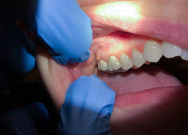 Best Knocked-Out Tooth Emergency  in Kimberling City, MO